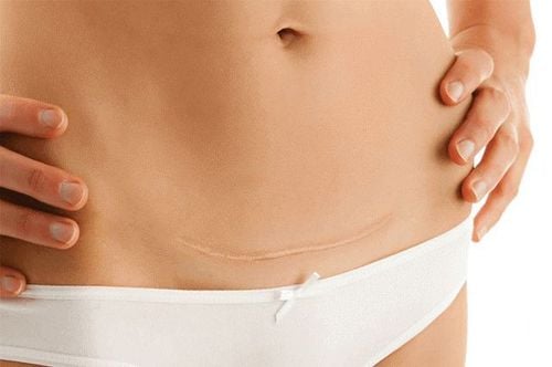 Chính vì quan tâm đến vóc dáng nên nhiều mẹ sau sinh nhờ đến sự hỗ trợ của nịt bụng