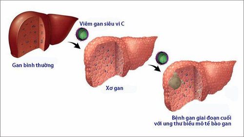 Viêm gan C là một trong những bệnh truyền nhiễm về gan, nguy hiểm do virus Hepatitis C virus (HCV) gây nên.