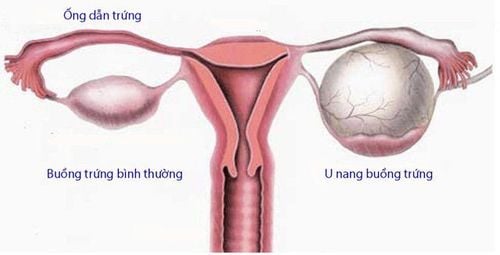 Nguyên nhân gây u nang buồng trứng rất đa dạng như sảy thai, mang thai, nhiễm trùng vùng chậu...