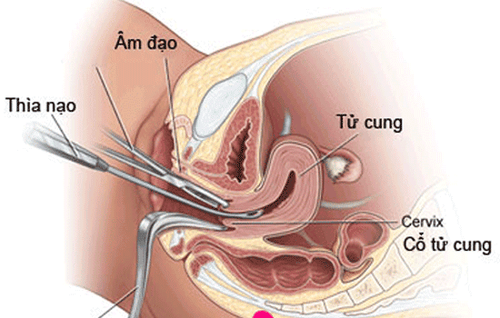 
Quy trình thực hiện nong và gắp thai
