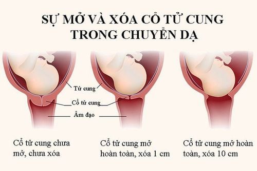 Cổ tử cung bắt đầu giãn và mở: dấu hiệu này xuất hiện vài ngày.