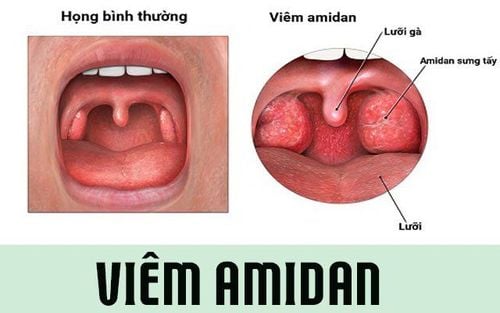 Viêm Amidan là một trong số nguyên nhân của loạn cảm họng