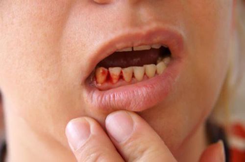 Chảy máu nướu răng là triệu chứng nặng của bệnh gan do rượu