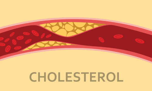 
Cholesterol cao có thể gây ra các vấn đề về tắc nghẽn mạch máu
