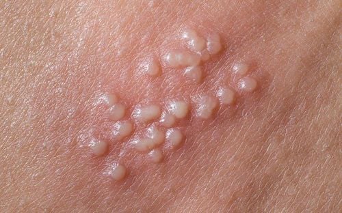 Anal Herpes: Symptoms and Treatment