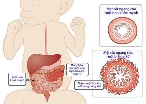 Intestinal infections are one of the causes of diarrhea in newborns.