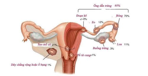 Thai ngoài tử cung có thể được điều trị thông qua phẫu thuật nội soi ổ bụng