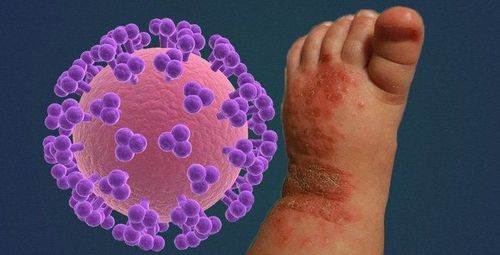 Herpes virus infection is a skin manifestation in children with HIV

