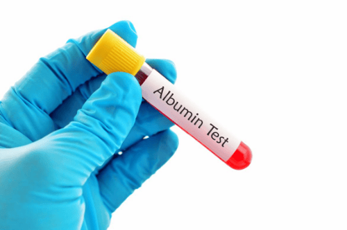 Người mắc bệnh huyết áp hoặc tiểu đường nên thực hiện xét nghiệm Microalbumin niệu