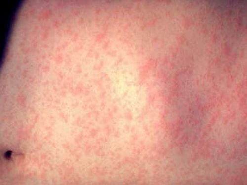 It is possible to differentiate between viral exanthematous fever and dengue fever by examining the rash.
