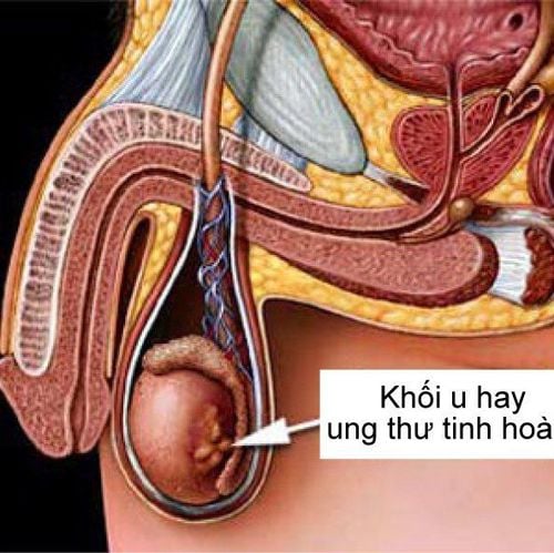 Các dấu hiệu bất thường thường bị bỏ qua dẫn đến nguy cơ mắc ung thư tinh hoàn càng cao