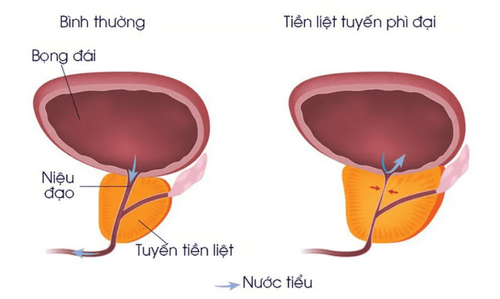 U xơ tuyến tiền liệt: Độ tuổi nào mắc bệnh và khi nào cần điều trị?
