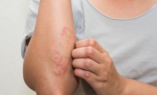 Collagen không thể điều trị tình trạng viêm da dị ứng