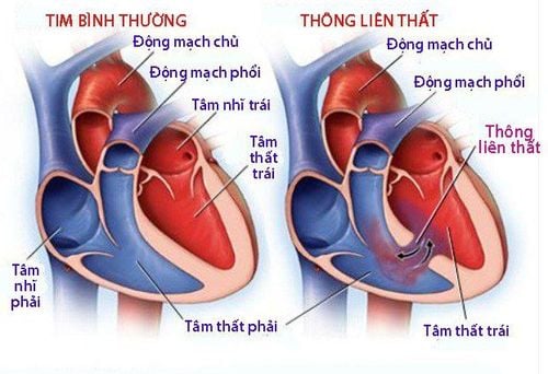 Thông liên thất