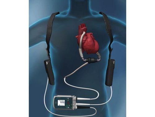 Thiết bị bơm HeartMate II là một máy bơm nhỏ hoạt động như động cơ phản lực