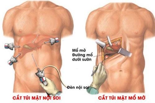 Ưu điểm của cắt túi mật nội soi là gì?