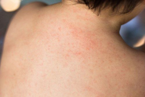 Rash-associated fever is the most common presentation