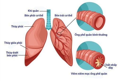 Bronchitis is characterized by inflammation of the lining of the bronchial tubes