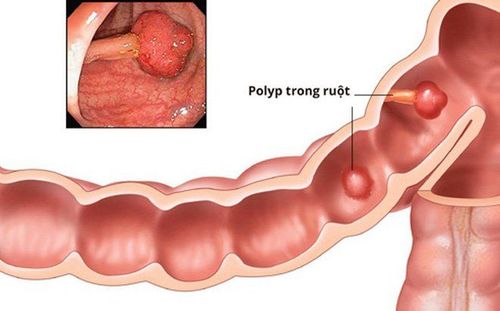 Colon polyps