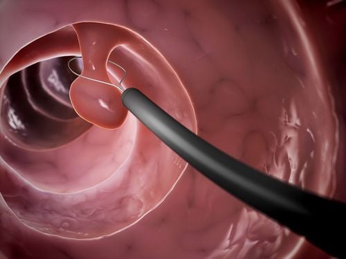 Do colon polyps grow back after removal?