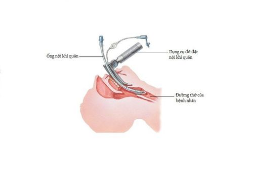 Bác sĩ tiến hành đặt nội khí quả qua đường miệng hoặc đường mũi