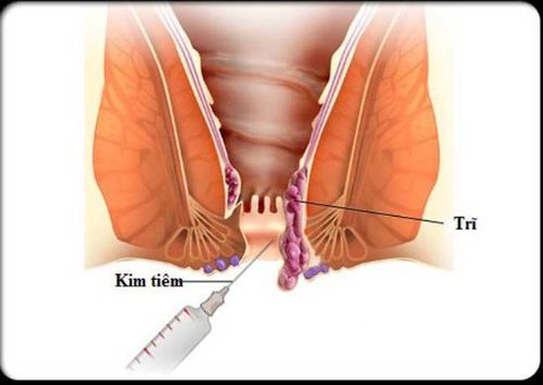 Phương pháp chích xơ điều trị trĩ nội độ 2.