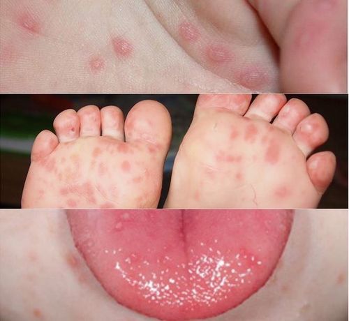 Biến chứng phổ biến nhất của bệnh tay chân miệng là gây lở loét ở miệng, đau đớn và mất nước
