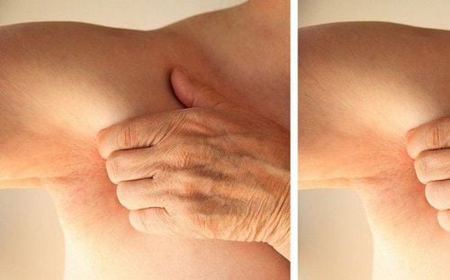 Itching in the armpit area and prominent red bumps are typical symptoms of armpit folliculitis.