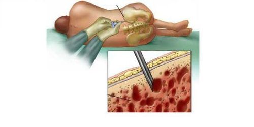 Sinh thiết tủy xương có thể không cần để khẳng định bệnh nhưng cần thiết trước khi tiến hành điều trị