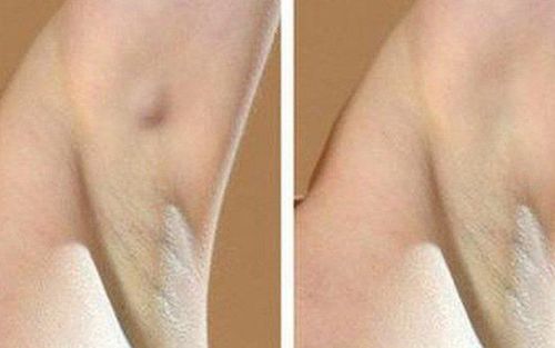 Swollen lymph nodes in the axillary (armpit) region are often associated with pain and inflammation.