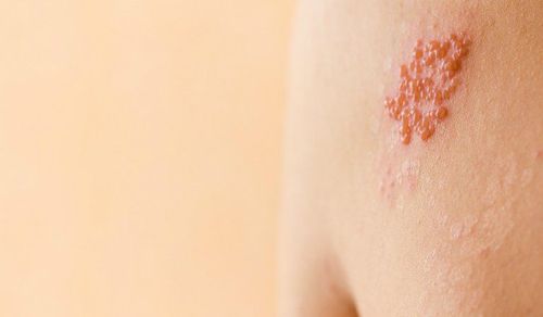 How to treat shingles on lips, mouth, and neck without leaving scars