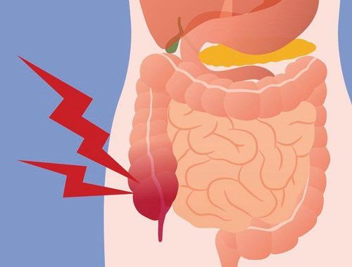 Áp xe ruột thừa là biến chứng của viêm ruột thừa cấp.