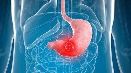 Gastritis Caused by Various Factors