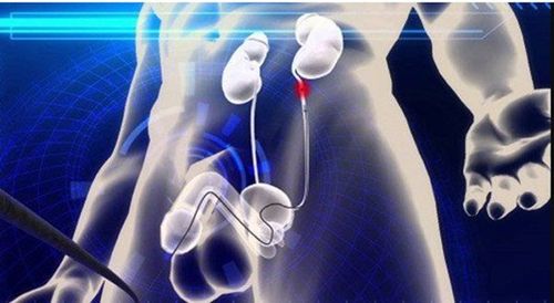 Kỹ thuật nội soi ngược dòng sử dụng ống soi niệu quản đi từ vùng niệu đạo, qua bàng quang và lên niệu quản