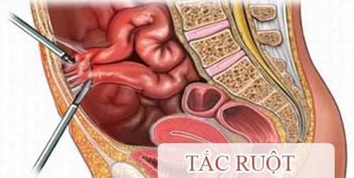 Bệnh nhân bị tắc ruột sẽ không được chỉ định thụt tháo