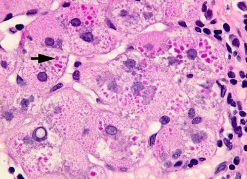 Xét nghiệm được chỉ định cho các bệnh nhân bị nghi ngờ có tình trạng thiếu hụt alpha 1 –antitrypsin bẩm sinh