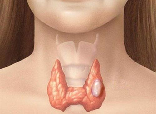 Nhân tuyến giáp được phát hiện tình cờ khi đi khám sức khỏe định kỳ
