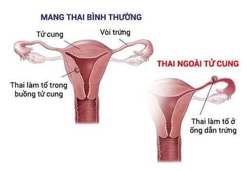 An ectopic pregnancy occurs when the embryo implants in the wrong location.