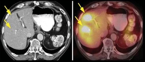 
Hình ảnh u máu gan trên CT (bên trái) và SPECT/CT (phải)
