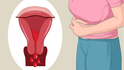 
Điều trị bệnh bằng nút mạch lạc nội mạc trong cơ tử cung
