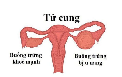 Ovarian cysts are a very common disease in women of reproductive age