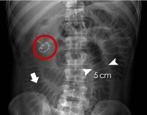 Bệnh nhân tắc ruột non được chỉ định thực hiện