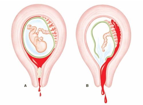 Vỡ tử cung là tai biến nguy hiểm, nếu không xử trí kịp thời có thể dẫn tới tử vong ở mẹ