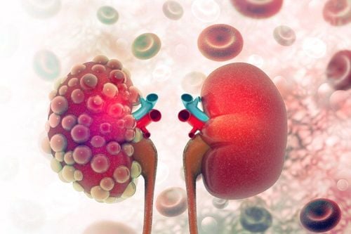 Sau ung thư tuyến giáp, người bệnh có nguy cơ mắc ung thư thận và một số loại ung thư khác