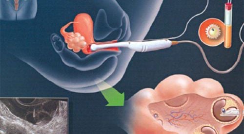 Hình ảnh buồng trứng được kích thích