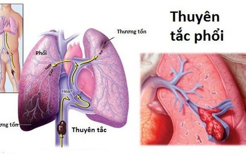 Pulmonary embolism is a condition where the blood vessels in the lungs are blocked by blood clots.