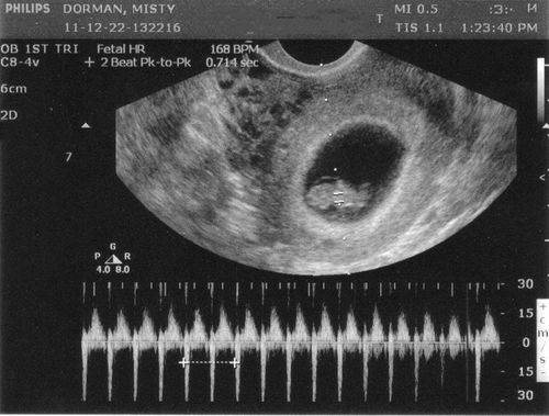 Tuần nào có thể siêu âm tim thai?