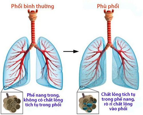 Phù phổi là biến chứng nguy hiểm của bệnh thận mạn gây nên