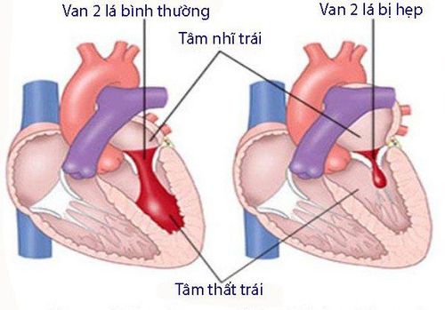 Mẹ bầu bị hẹp van 2 lá được chỉ định gây mê nội khí quản phẫu thuật lấy thai