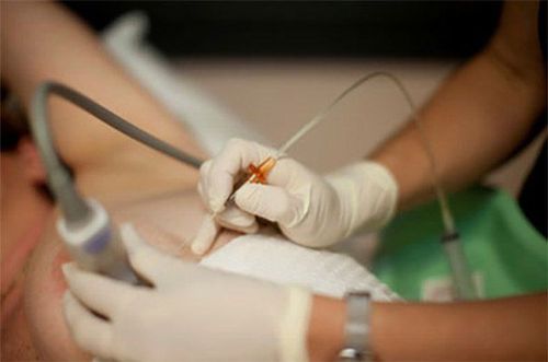 Sinh thiết vú là thủ thuật lấy bỏ 1 mẫu mô vú để gửi phòng giải phẫu bệnh khảo sát mô học và tế bào các tổn thương vú
